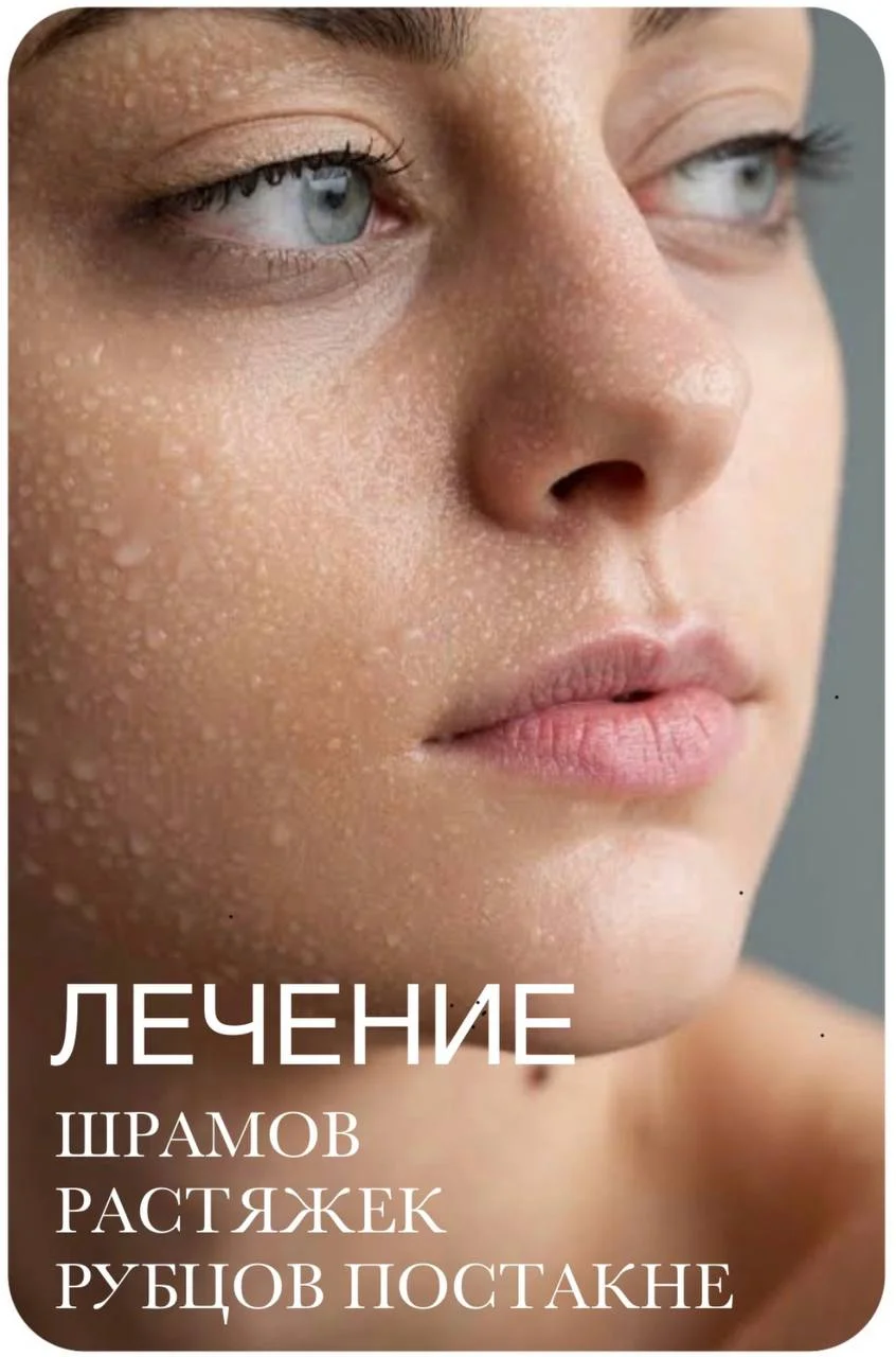 Коллагенотерапия - микроигольчатая процедура (Ирина)